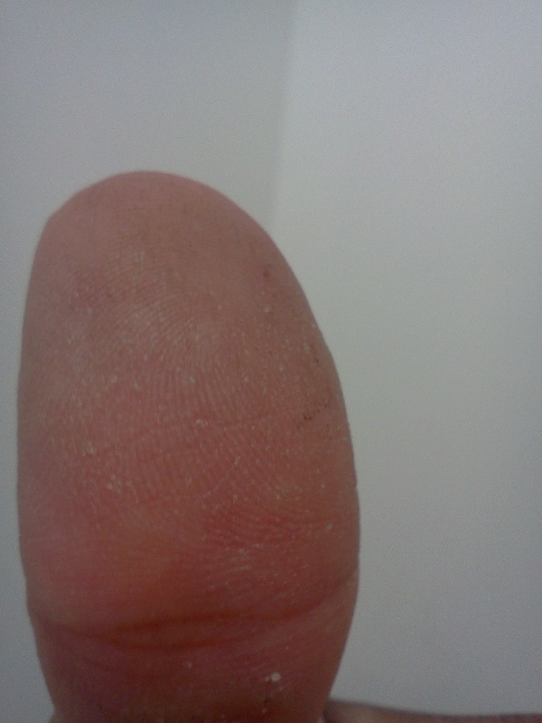 a shredded thumb....
